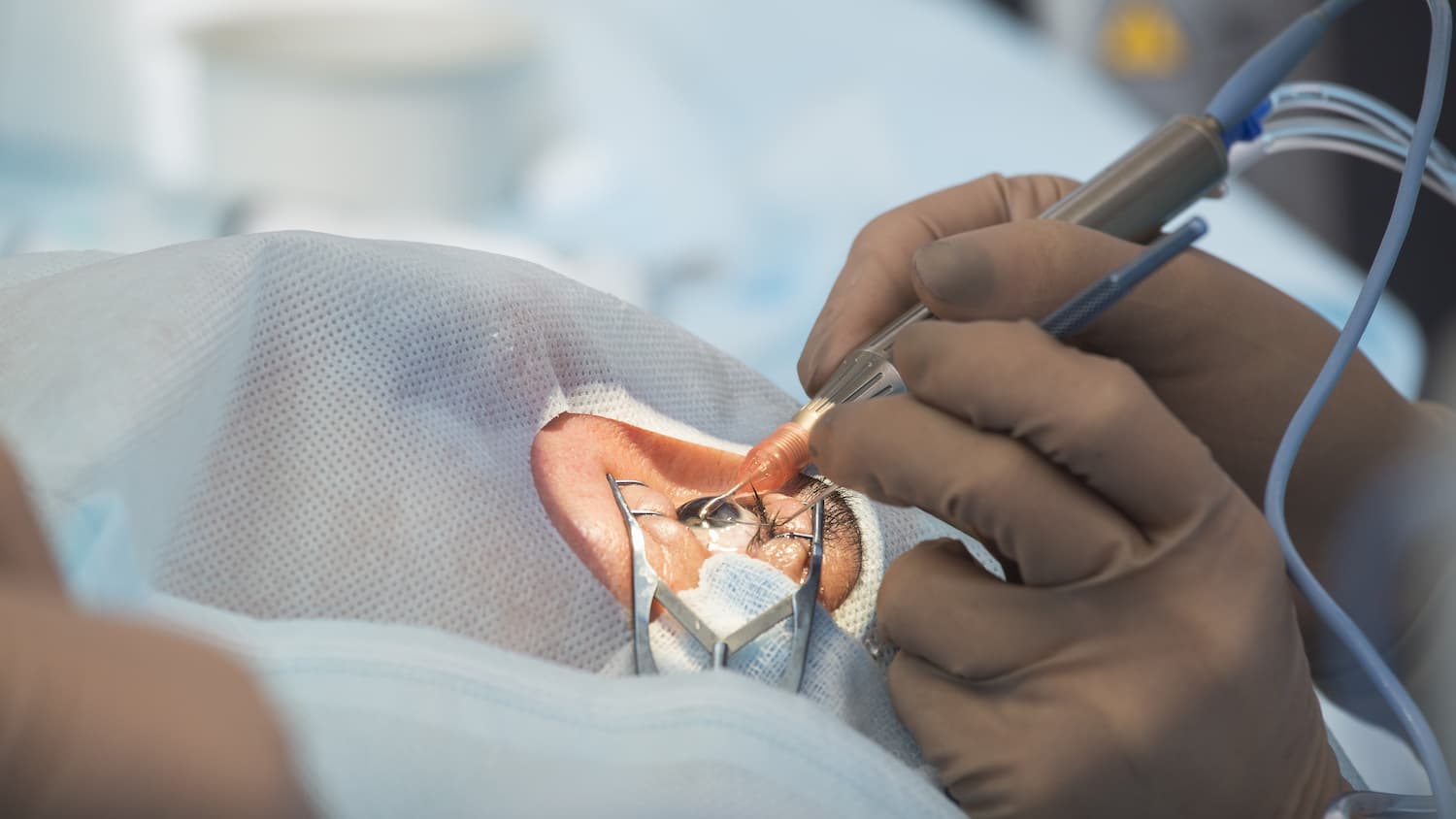 chirurgie yeux senior